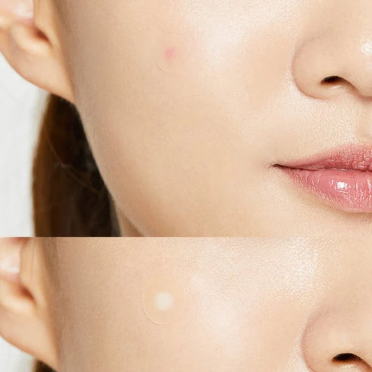 Patchs anti-acné COSRX Master (24 patchs)